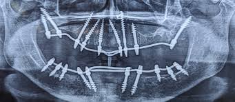 Basal Implant