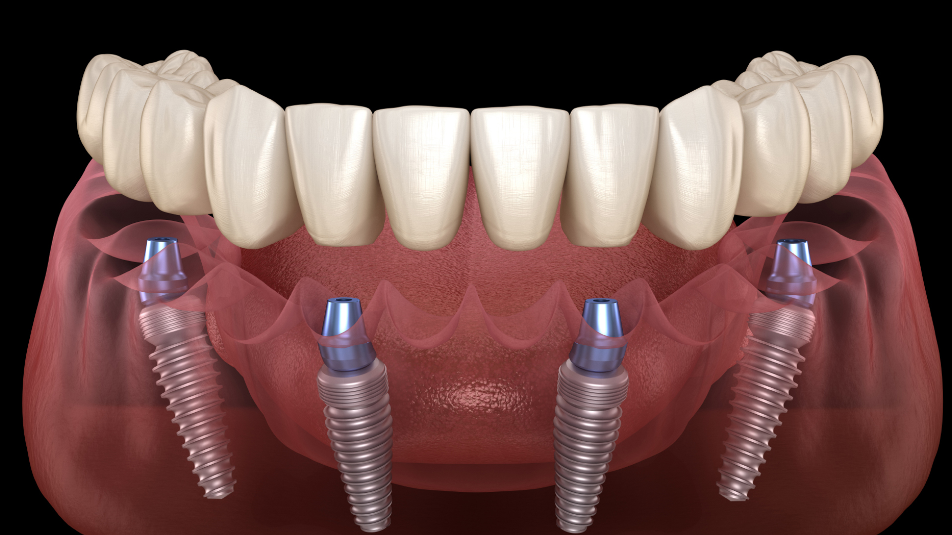 Dentalia smiles