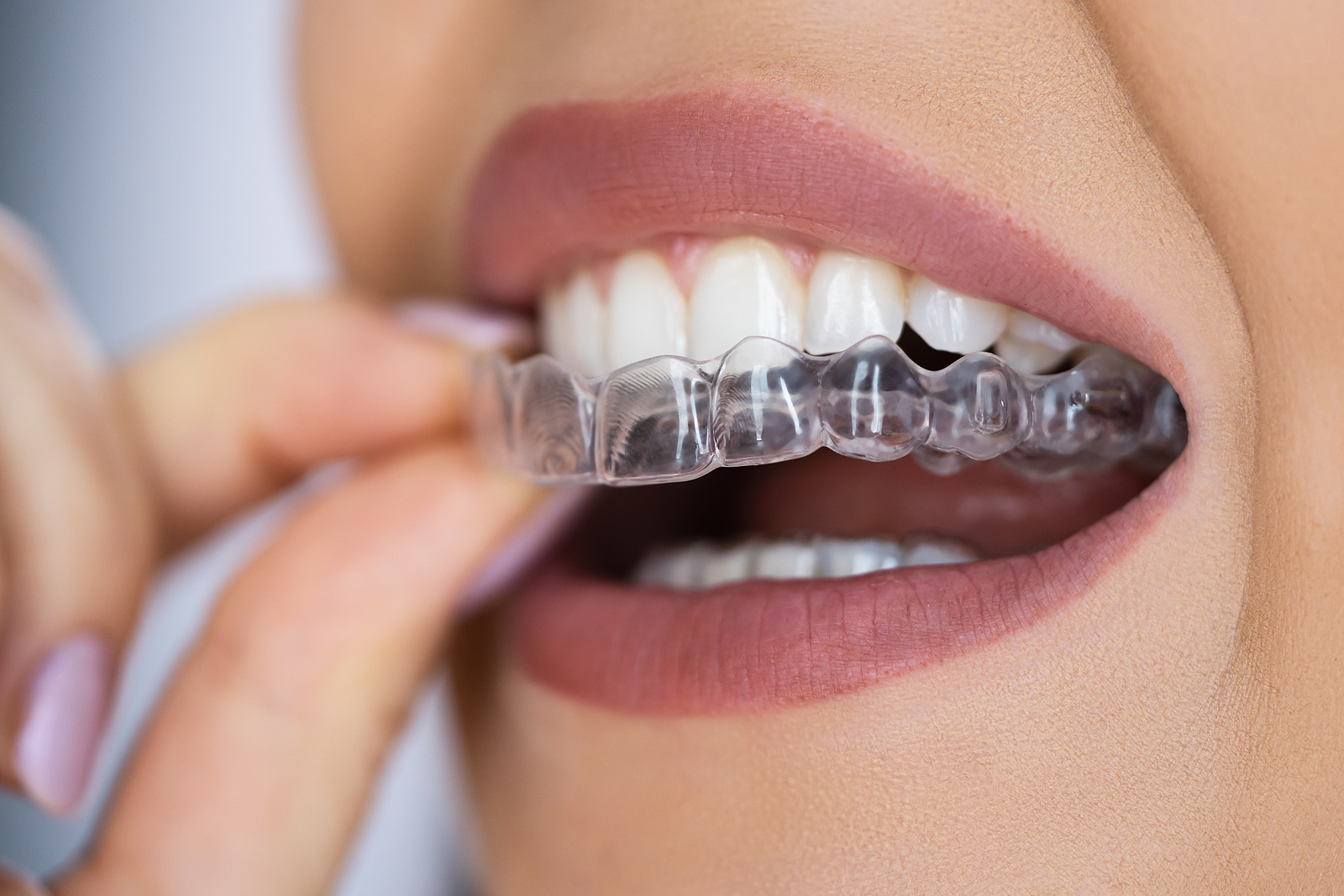 Invasive Aligners