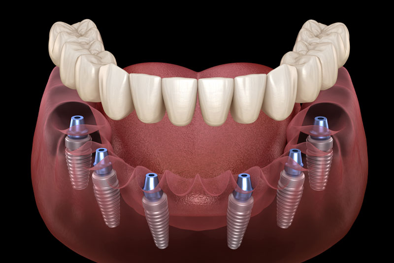 Dentalia smiles