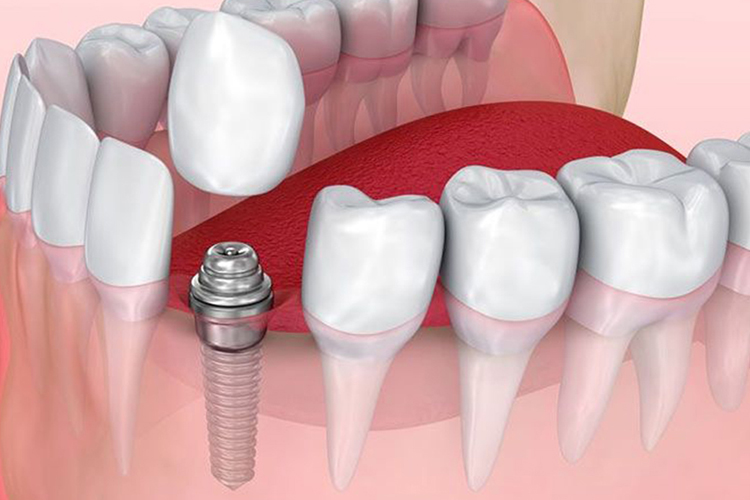 dental-implantsi