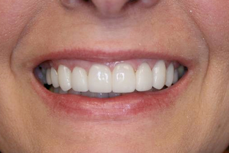 dental-veneersi